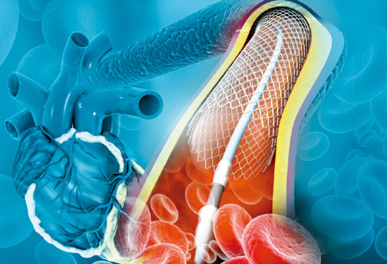 冠狀動脈鈣化血管處理的新技術 | am730