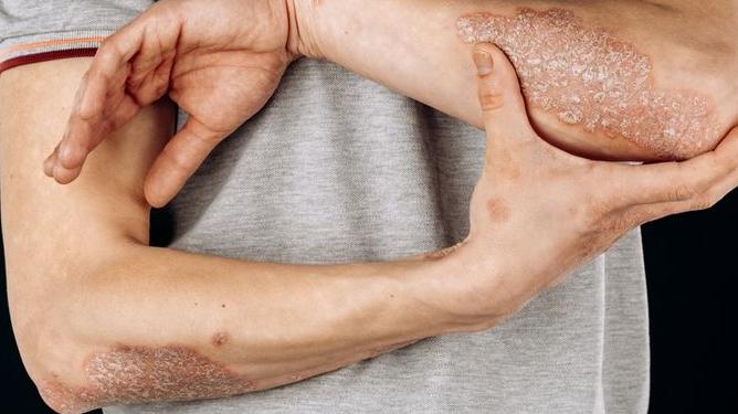 為何有些人的免疫功能比較弱？　專家「特殊自體免疫機制」惹禍