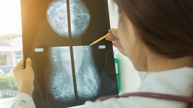 乳房有良性腫瘤應否做手術切除？家族史有風險切咗較好！