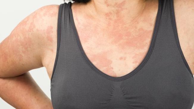 全身起疹又紅又痕以為生風癩 check完發現係甲狀腺出事？！