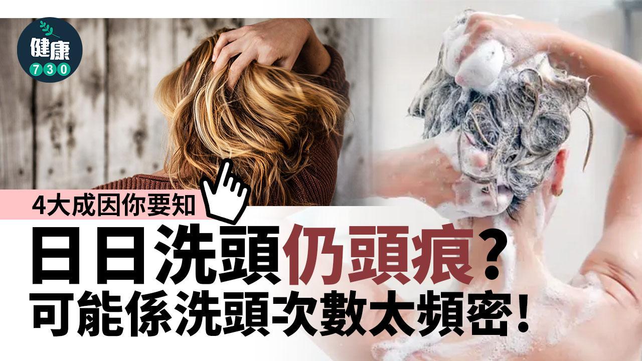 日日洗頭仍頭痕？可能係洗頭次數太頻密（am730製圖）