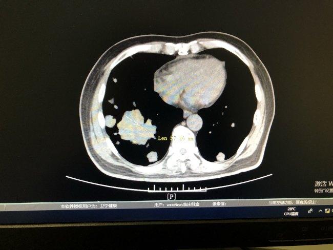 浙江婦抗癌8年家人不離不棄　殘疾夫及奶奶打工籌醫藥費