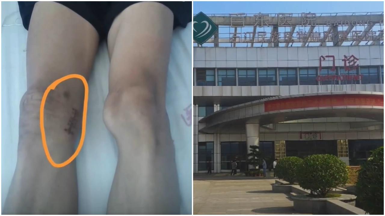 17歲體育學生左膝生骨瘤，慘遭三甲醫院醫生誤切右膝。(微博)