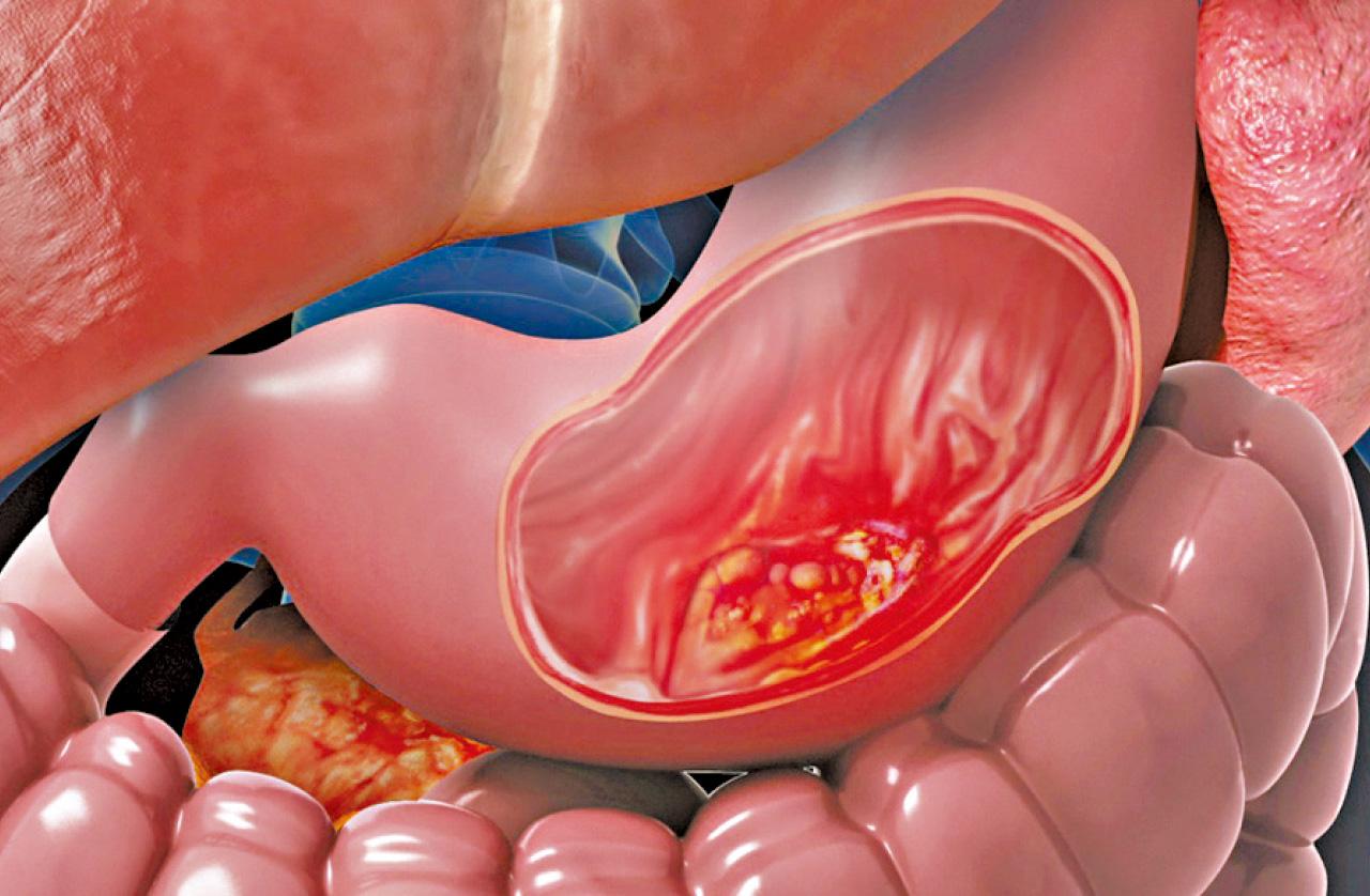 照胃鏡篩查癌變
