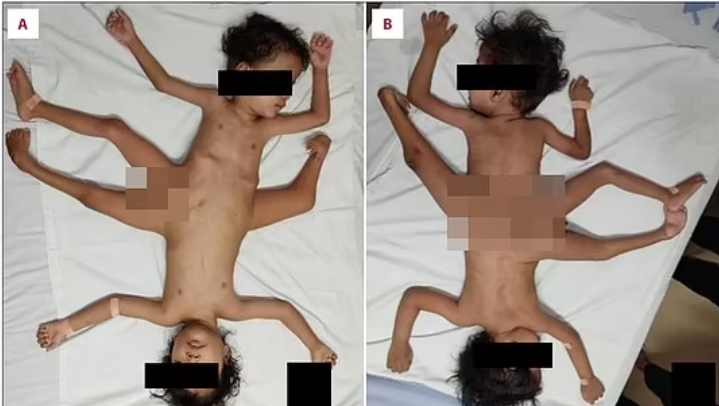 印尼一對連體嬰兄弟出生時下半身「融合」，共用3條腿、4隻手臂以及1根陰莖，兩人同時共享膀胱、直腸以及腸道，情況極之罕見，因為二人身體相連如蜘蛛，因此被稱為「蜘蛛連體雙胞胎」（Ischiopagus Tripus），有關病例報告發表在最新一期美國醫學期刊。