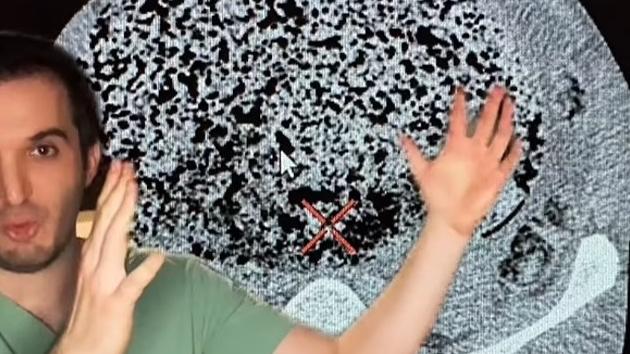 醫生沙法請解男子3個月沒排便的病例。(互聯網)