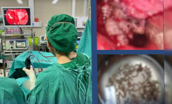 泰國婦鼻塞頭痛一星期求醫　手術揭鼻腔藏上百條蛆蟲
