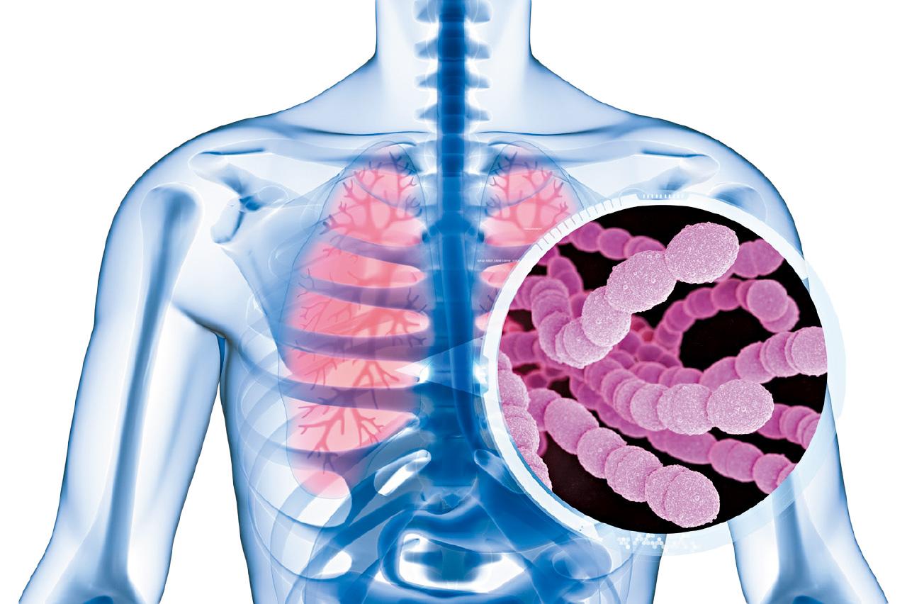 小心三高肺炎球菌