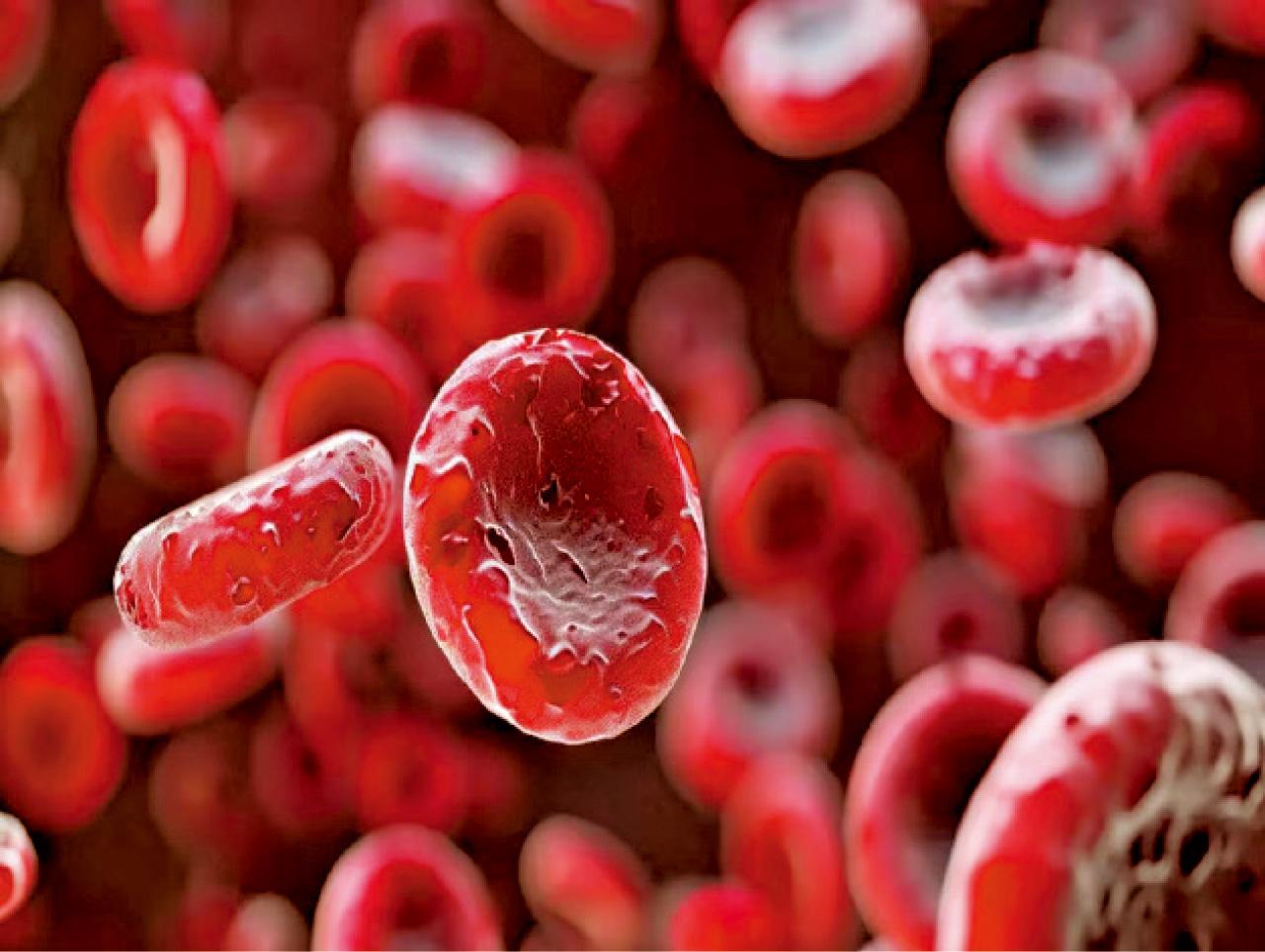 重型地貧患者有望減少對輸血的依賴