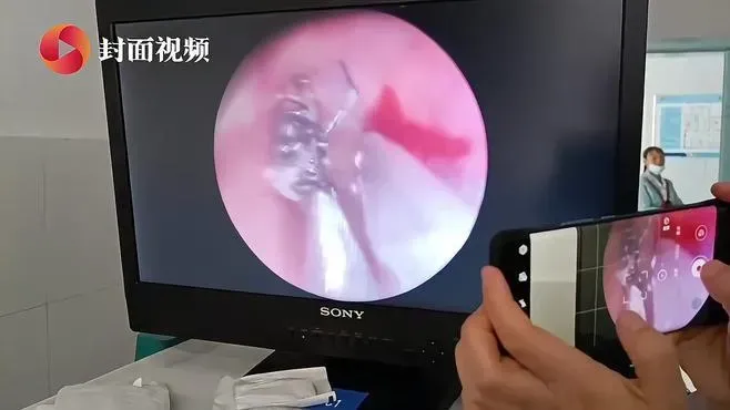 深圳女頭暈耳鳴兩星期求診　揭耳內藏活蟲　鼓膜有蟲卵