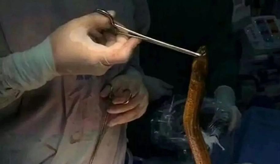 65厘米活鰻塞肛門遭咬穿腸，醫生開刀仲見青檸。