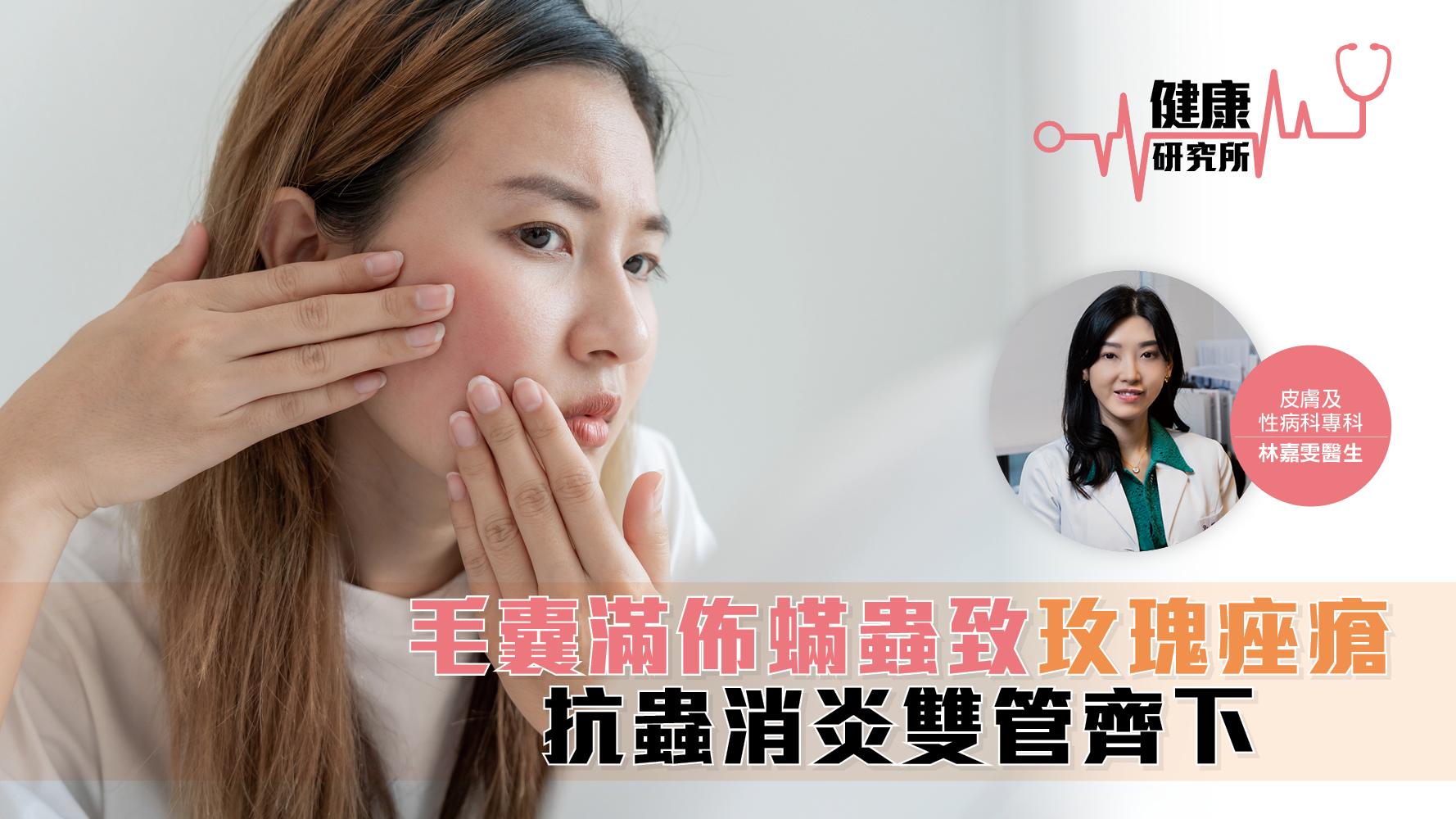 健康研究所｜毛囊滿布蟎蟲致玫瑰痤瘡 抗蟲消炎雙管齊下
