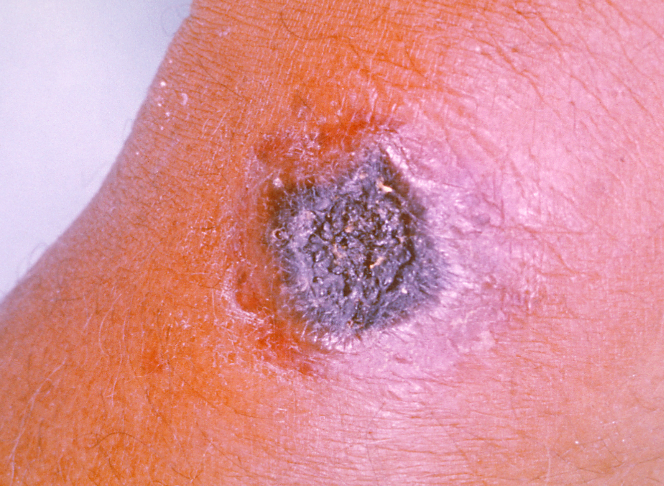 炭疽病造成的皮膚病變(資料圖片)