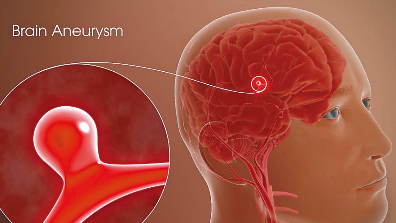堵塞腦動脈瘤 拆彈不留痕