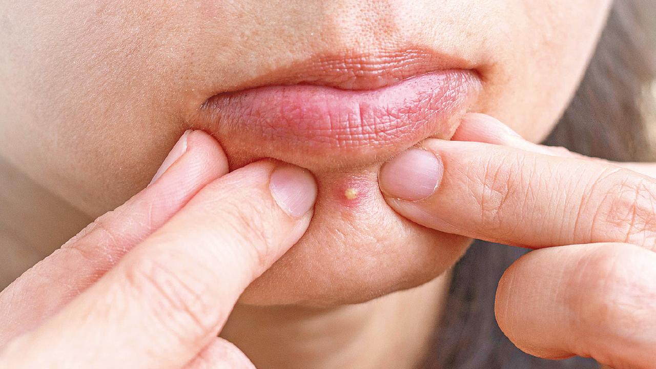 擠暗瘡 隨時留疤