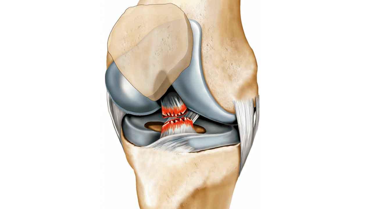 十字韌帶受傷與劍擊運動
