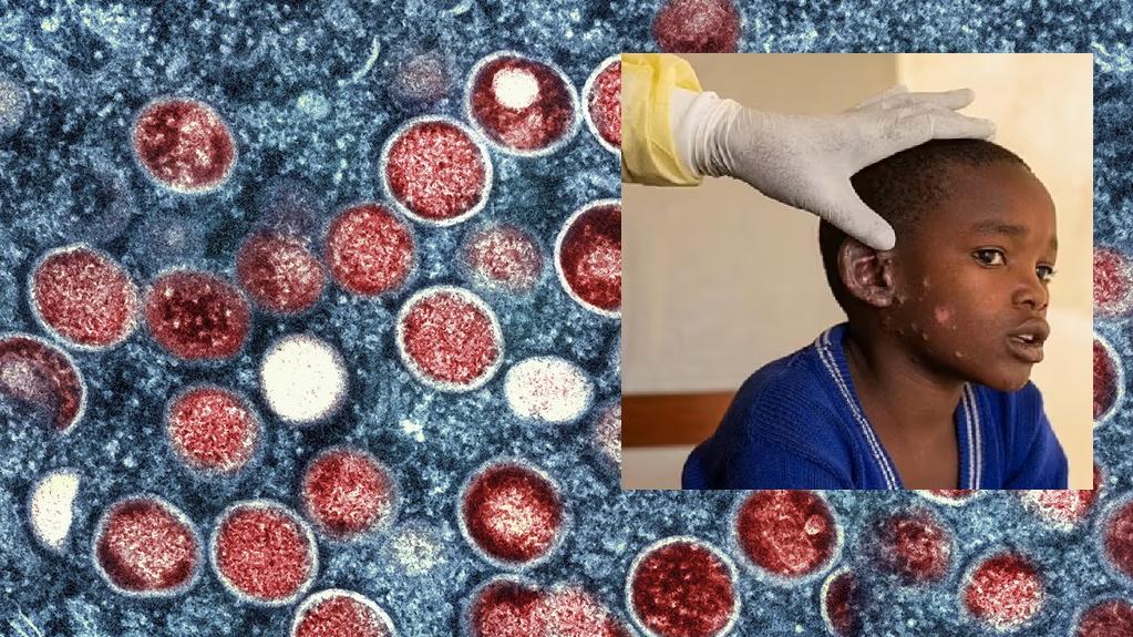 猴痘｜為何再列世衛警示？涉更致命新品種 專家預言英國將有人死 歐洲將爆發