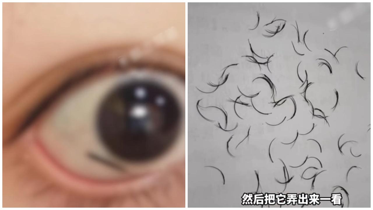 江西女眼角露出黑色異物，愈拉愈長竟然拉出74條這東西。(微博)