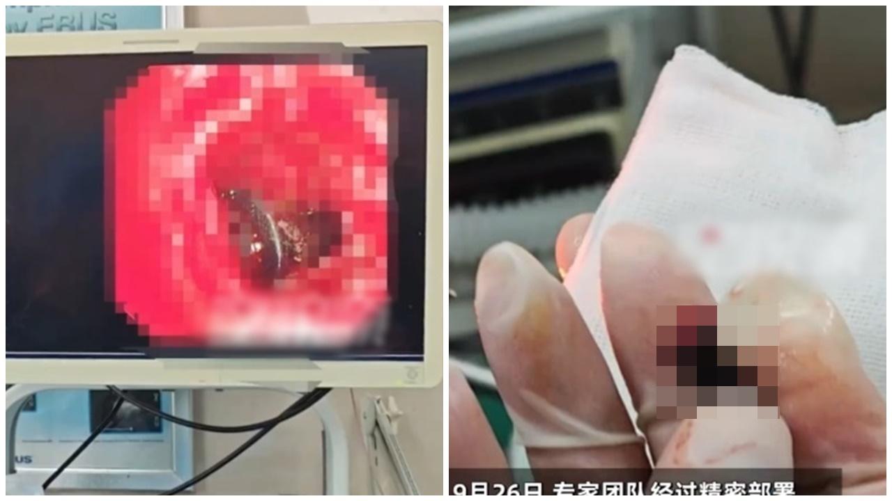 安徽男遇交通意外入院檢查，驚揭咳嗽28年之謎。(微博)