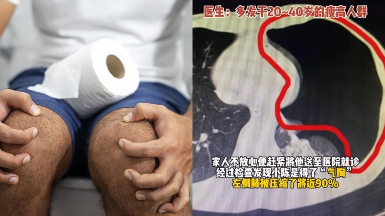 男子便秘太用力谷爆肺，左肺被壓縮近90%。