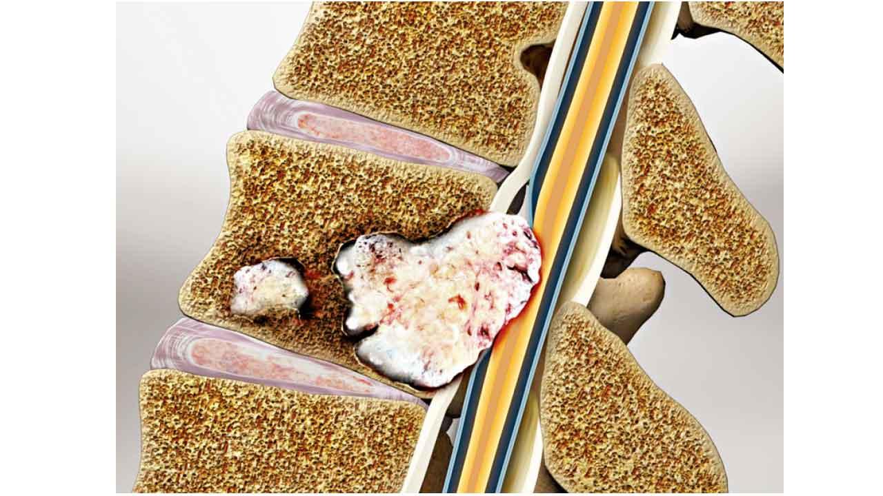 頸椎疼痛蔓延全身的特殊情況