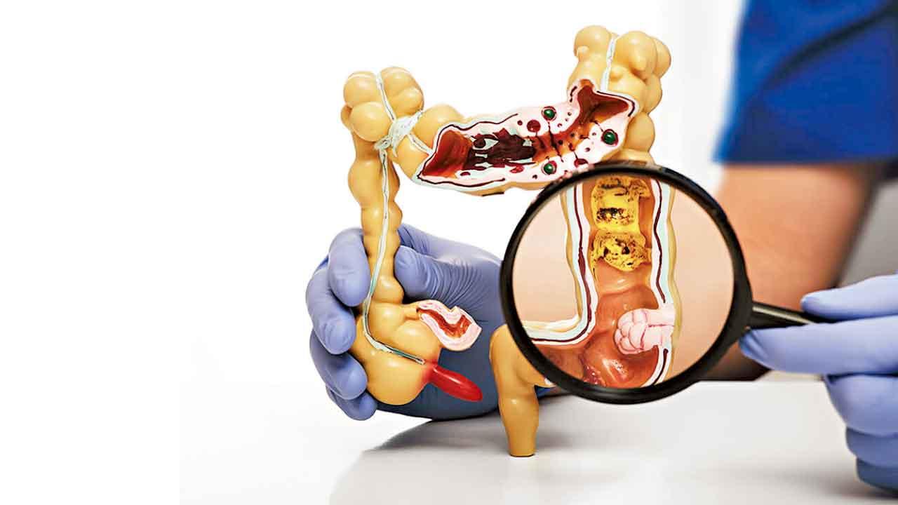 機械臂輔助 增加根治大腸癌機會