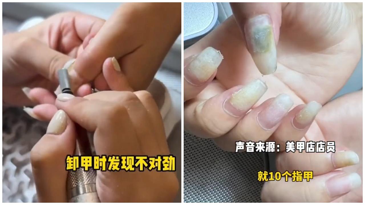雲南女長期美甲驚見十指變空甲，還長綠色霉菌。(微博)