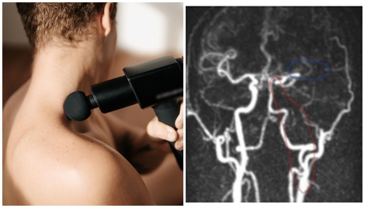 南京漢按摩槍按摩頸部，腦血管栓塞歪咀中風。