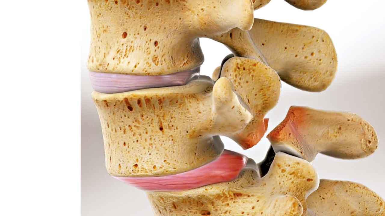 脊椎滑脫未必覺痛？影像檢查問症同樣重要
