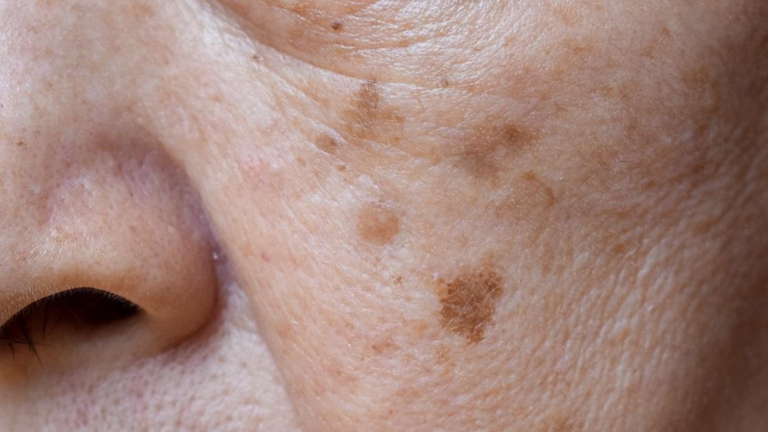 曬斑大多是平的，好發於臉部、四肢外側。