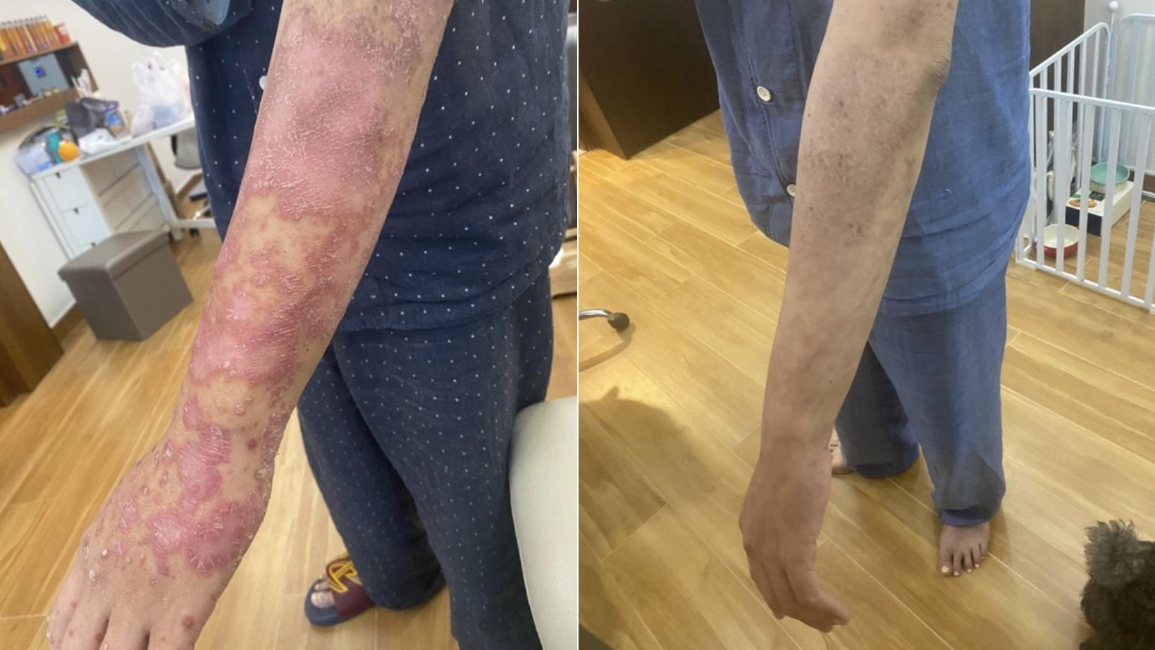 銀屑病︱有銀屑病患者說，接受生物製劑後，情況改善。（香港銀屑病友會提供）