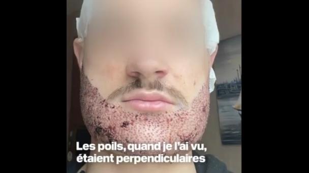 拉托爾臉部移柤鬍鬚的位置灼傷紅腫。(互聯網)