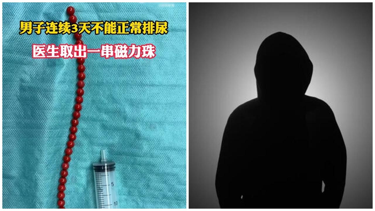 寧波漢3日無屙尿，醫生於尿道取出一串磁力珠。