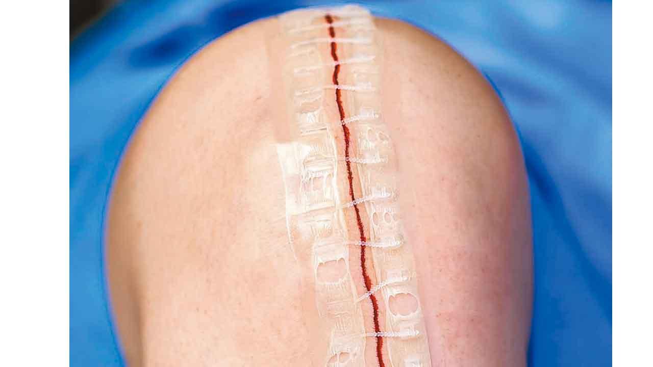 拉鏈縫合 加快「換骹」傷口復原