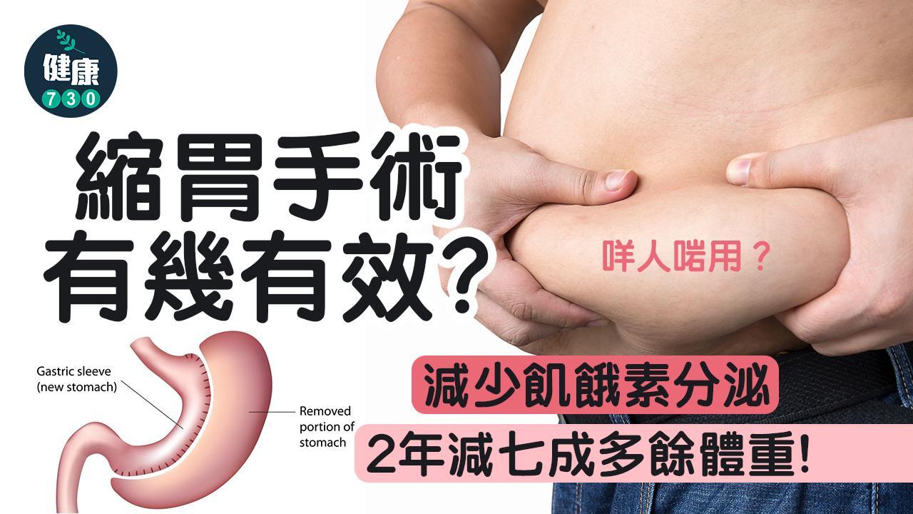 減肥｜縮胃手術有幾有效？原理係點？咩人啱用？（am730製圖）