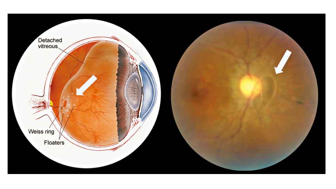 飛蚊可怕不可怕