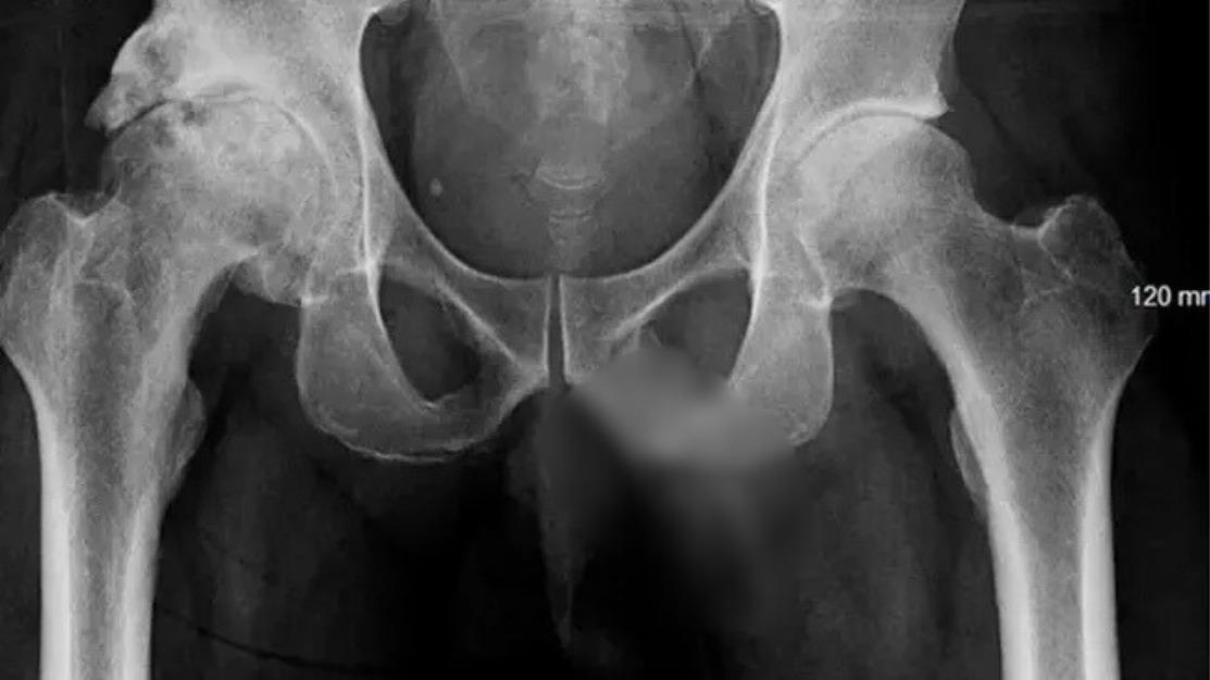 陰莖骨化症｜六旬漢跌傷求醫竟驗出罕見病 全球患者僅40人