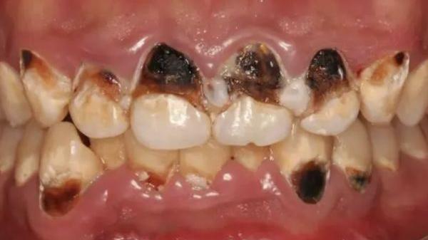 武漢少女可樂當水飲　全排牙變黑泡爛急求醫