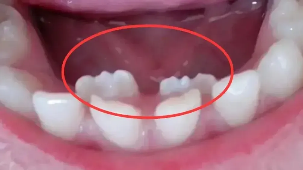 湖北6歲女生出兩排牙　揭家人太愛錫只餵易消化食物