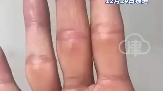 山東24歲男零培訓誤觸儀器輻射源　雙手腐爛料截肢