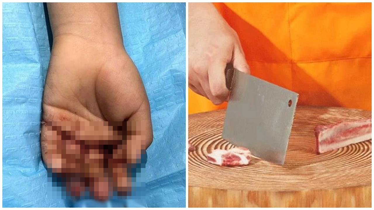 廣東婦煮飯兼顧不暇，一刀剁去4歲兒3隻手指。