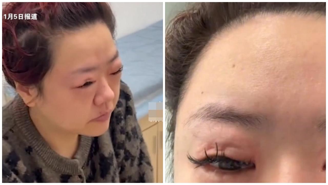 廣東女喪食3公斤車厘子後發燒，其後藥物過敏慘變Pepe蛙。(微博)