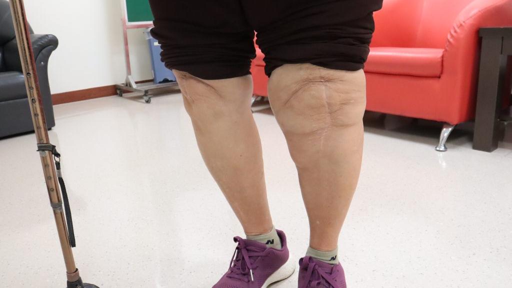 謝姓婦人年輕時以務農維生，在缺乏現代化農具輔助的年代，必須長期跪姿採收豌豆等農作物，導致膝關節承受極大負荷而嚴重退化。