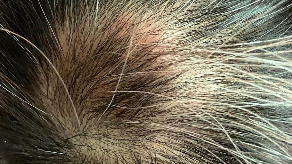 梅花針治療斑禿個案