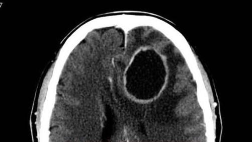 醫生公布老婦的檢查影像，顯示她患上腦部膿瘍。(互聯網)
