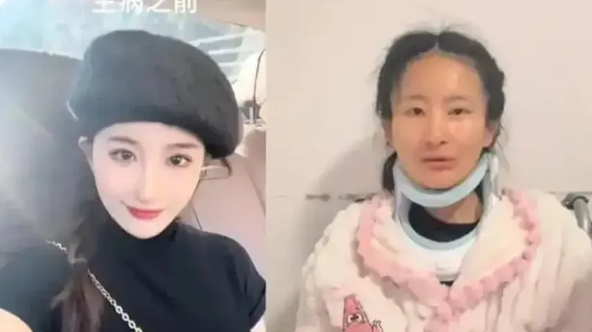 湖南26歲女確診漸凍症　一年間容貌判若兩人