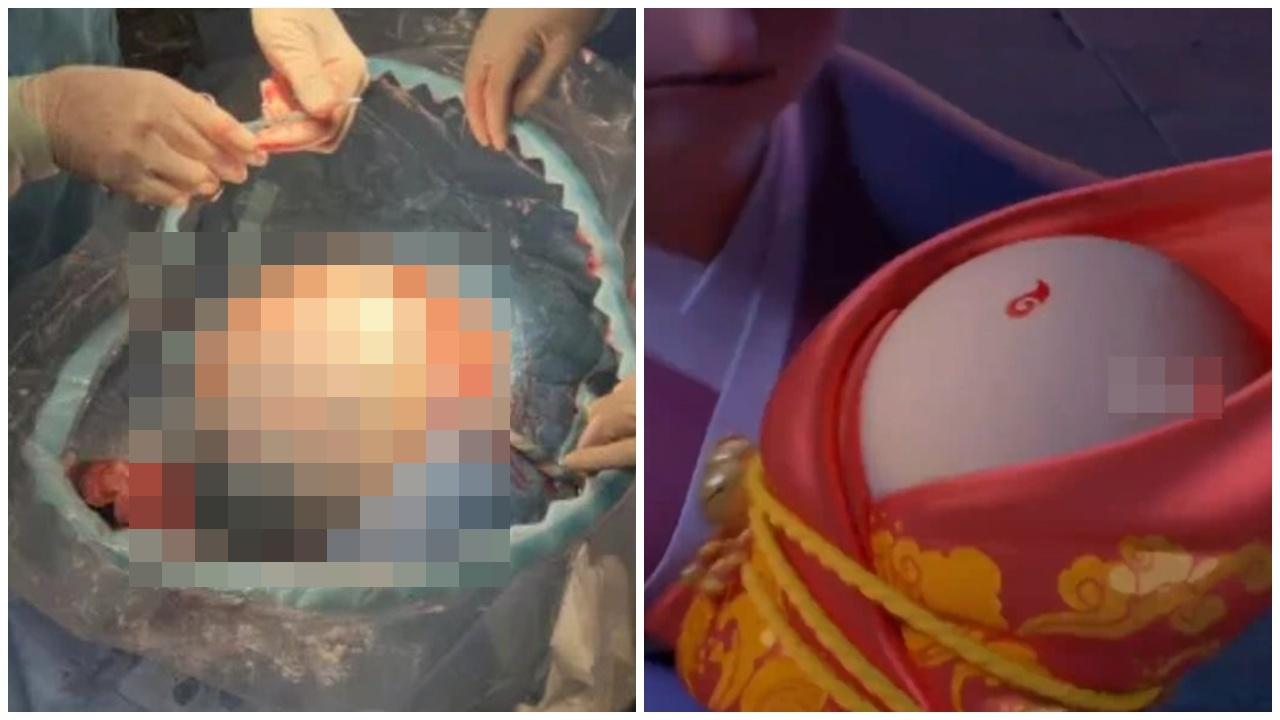 浙江婦生「球狀」雙胞胎，網民震驚「現實版哪吒降世」。