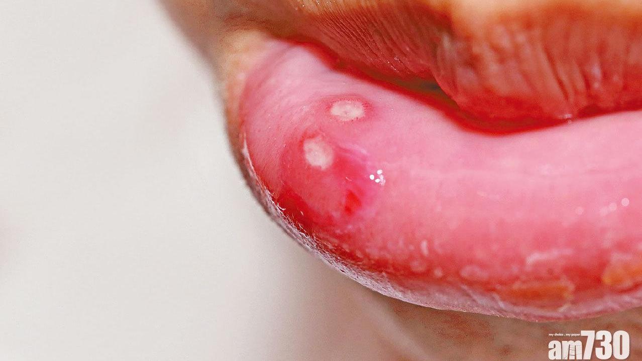 復發性口瘡 要分清火種