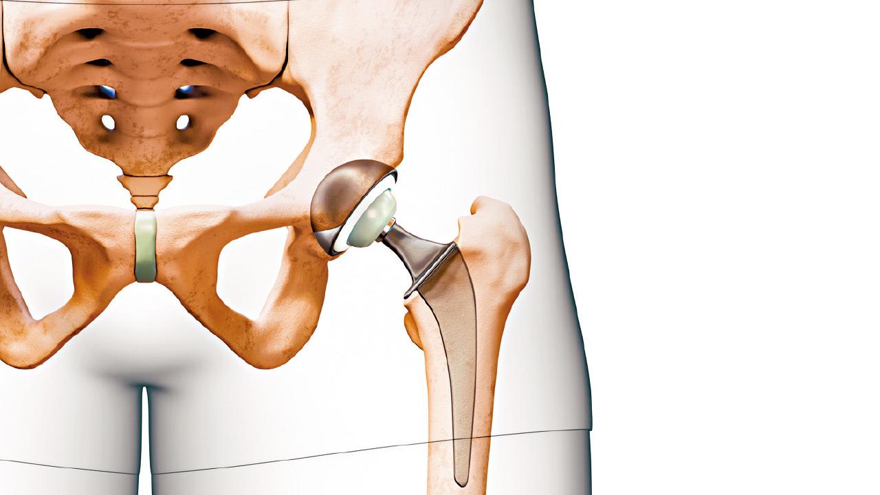 酗酒恐致骨枯 髖關節置換重拾活動能力