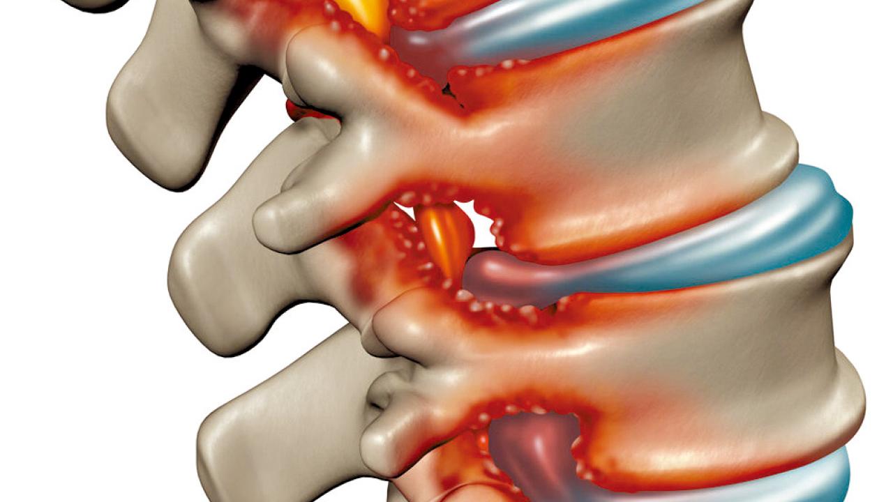 長者的坐骨神經痛